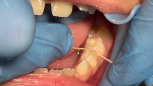 Le vernis fluoré: protocole d’application