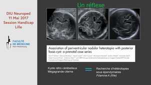 Anomalies de la Fosse Postérieure - Stephanie Valence