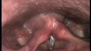 Nasofibroscopie normale.mp4