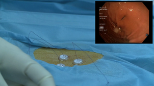 Pose de bouton de gastrostomie méthode introducer.mp4