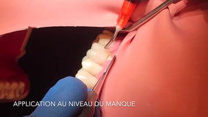 Vidéo Tuto :  Techniques de rebasage d'une couronne provisoire en résine bis-acryl